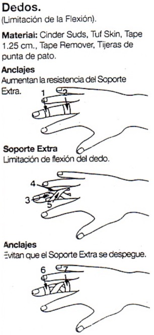 Capsulitis en la articulación interfalángica de la mano